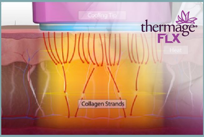 Thermage Bulk Heating