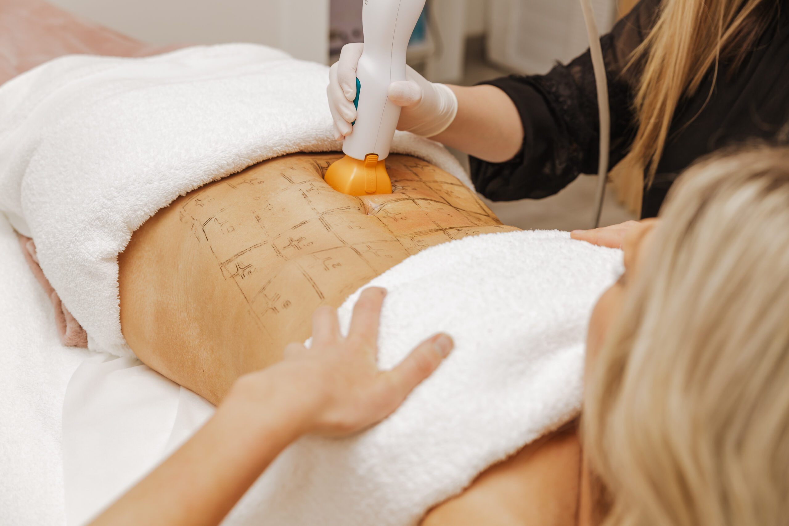Thermage FLX System for body