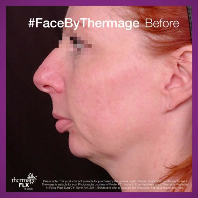 #BeforeAndAfter

Thermage can help to deliver noticeable results in a single treatment. 
Softened lines around the mouth, eyes, forehead; improved definition on jawline and under the chin.

Thermage results may continue to improve for up to six months. 

Contact your local Thermage provider and learn if Thermage can help you. Find a provider with our handy locator tool at https://thermage.com.au/find-a-provider/ or find the link in our bio.

Reference: Polder KD, Bruce S. Radiofrequency: Thermage. Facial Plast Surg Clin North Am. 2011 May;19(2):347-59. doi: 10.1016/j.fsc.2011.04.006. PMID: 21763995.

Please note: This product is not available for purchase by the general public. Please consult your practitioner to see if Thermage is suitable for you.

#BeforeAndAfter #ForAllSkinKind #AllSkinTypes #RealResults #LastingResults #SkinRejuvenation #NonInvasive #Skin #SkinHealth #HealthySkin #Collagen #Wrinkles #Face #Eyes #Body #Thermage #ThermageFLX #ThermageAU #ThinkThermage #Radiofrequency #GetBackToTheRealYou #BeAnOriginal