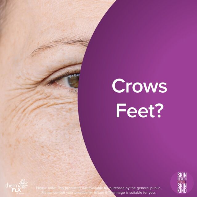 Thermage helps improve the look of crow's feet, providing smoother, more awakened eyes. 
#ThermageEyes

A treatment is not limited by skin type, male/female or age.
Ageing is what you make of it. Thermage FLX treatments can help make it easier. 

To see more Thermage before and after results head to https://thermage.com.au/results/ or click the link in our bio. 

Please note: This product is not available for purchase by the general public. Please consult your practitioner to see if Thermage is suitable for you.

#CrowsFeet #Eyes #ForAllSkinKind #AllSkinTypes #LastingResults #SkinRejuvenation #NonInvasive #Skin #SkinHealth #HealthySkin #Collagen #Wrinkles #Thermage #ThermageFLX #ThermageAU #ThinkThermage #Radiofrequency #GetBackToTheRealYou #BeAnOriginal