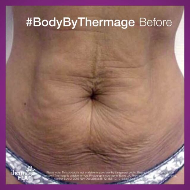 Here are some Before & After results addressing skin laxity on the abdomen with Thermage.
After photos were taken immediately after treatment, as well as 2 months after treatment.
Photographs courtesy of Burns JA. Thermage: monopolar radiofrequency. Aesthet Surg J. 2005 Nov-Dec;25(6):638-42. doi: 10.1016/j.asj.2005.09.017. PMID: 19338872.
Please note: This product is not available for purchase by the general public. Please consult your practitioner to see if Thermage is suitable for you.
#ThermageEyes #AwakenedEyes #ForAllSkinKind #AllSkinTypes #RealResults #LastingResults #SkinRejuvenation #NonInvasive #Skin #SkinHealth #HealthySkin #Collagen #Face #Eyes #Body #Thermage #ThermageFLX #ThermageAU #ThinkThermage #Radiofrequency #GetBackToTheRealYou #BeAnOriginal