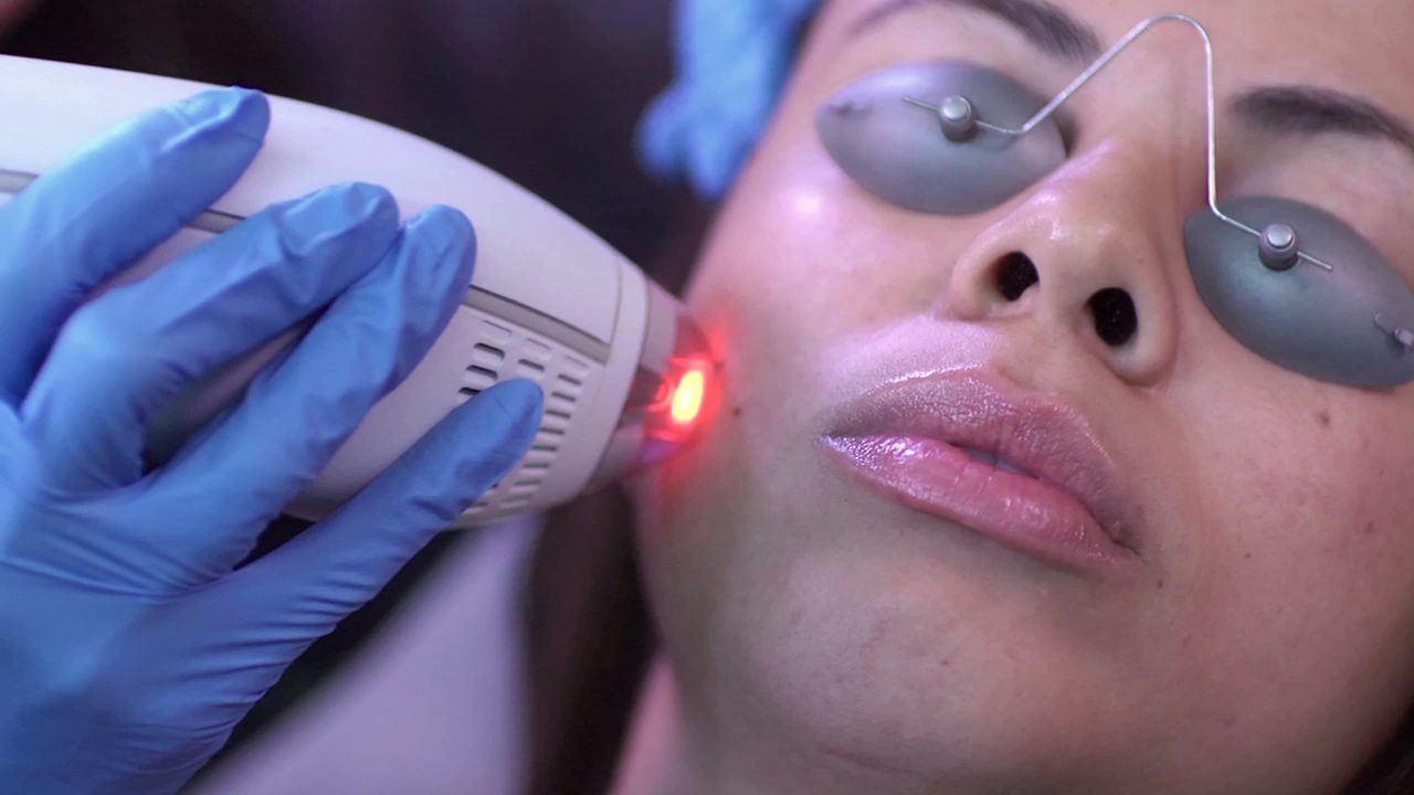 A Typical Clear + Brilliant Treatment A Typical Clear + Brilliant Treatment